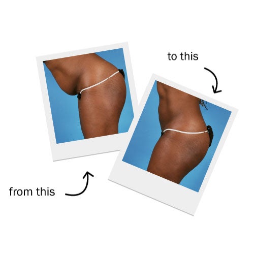 Cellulite Reduction in San Marcos, TX - Aesthetics of Central